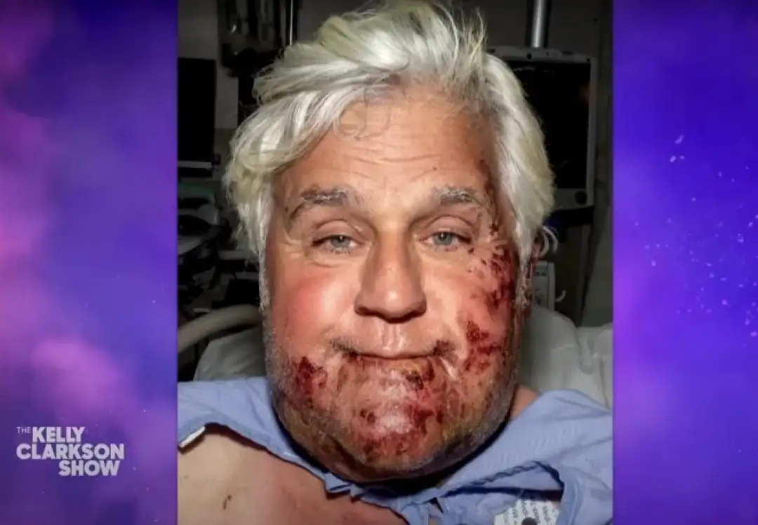 Џеј Лено, изгореници