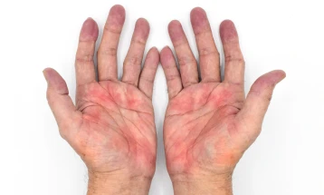 Долгото црвенило на дланките може да е знак за замастен црн дроб