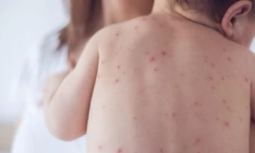 OBSH bëri thirrje për vaksinim të fëmijëve kundër fruthit
