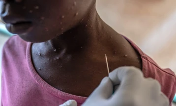 Mpox spreads to Zambia and Ghana, with 16 countries now affected