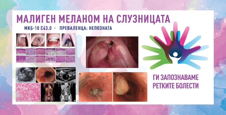 „Ги запознаваме ретките болести“: малиген меланом на слузницата