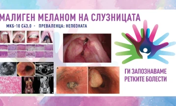 „Ги запознаваме ретките болести“: малиген меланом на слузницата