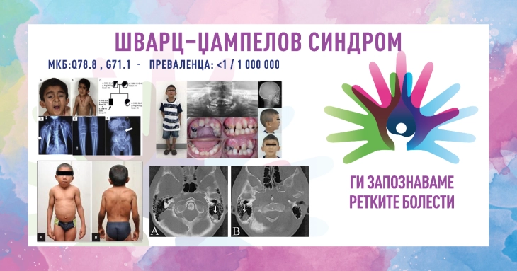 „Ги запознаваме ретките болести“: Шварц-џампелов синдром/Хондродистрофична миотонија/SCHWARTZ–JAMPEL SYNDROME