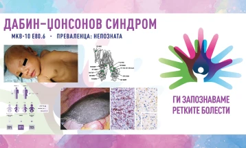 „Ги запознаваме ретките болести“: Дабин-џонсонов синдром