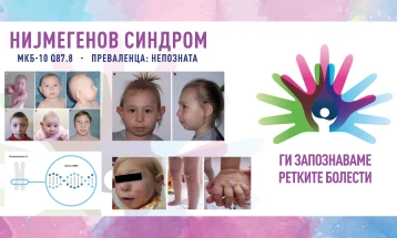 „Ги запознаваме ретките болести“: Нијмегенов синдром на раскинување/Нијмегенов синдром на кршење