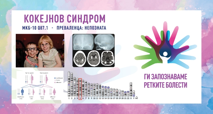 „Ги запознаваме ретките болести“: Кокејнов синдром