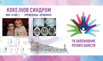 „Ги запознаваме ретките болести“: Кокејнов синдром