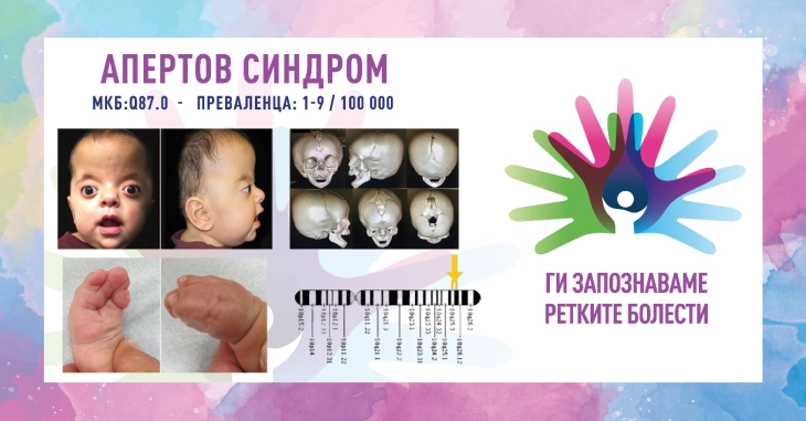 „Ги запознаваме ретките болести“: Апертов синдром