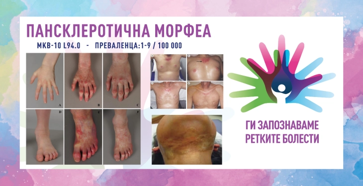 „Ги запознаваме ретките болести“: Пансклеротична морфеа