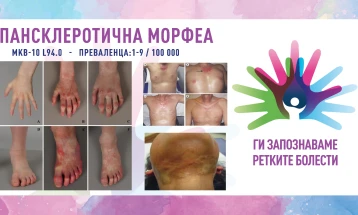 „Ги запознаваме ретките болести“: Пансклеротична морфеа