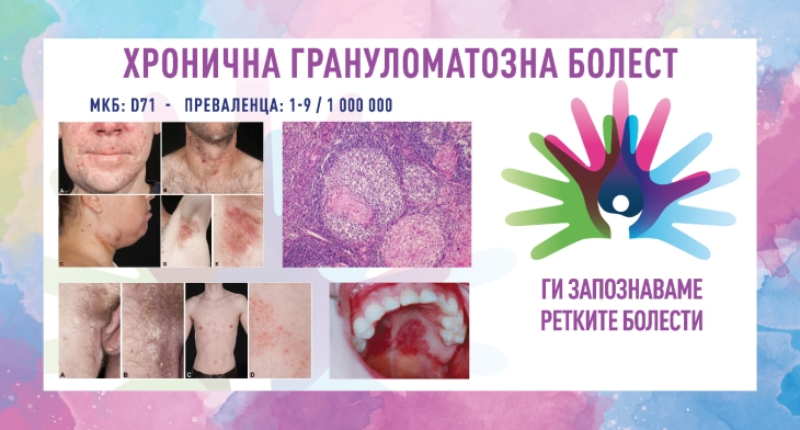 „Ги запознаваме ретките болести“: Хронична грануломатозна болест