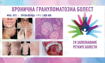 „Ги запознаваме ретките болести“: Хронична грануломатозна болест