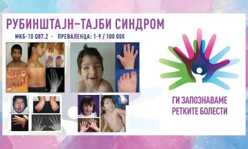 „Ги запознаваме ретките болести“: Рубинштајн–Тајби синдром