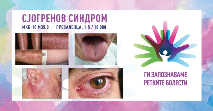 „Ги запознаваме ретките болести“: Сјогренов синдром