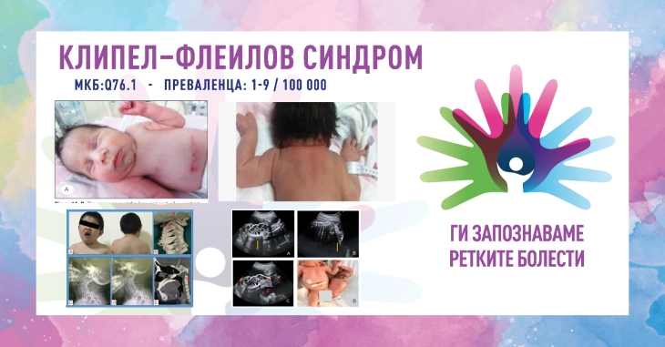 „Ги запознаваме ретките болести“: Клипел-Флеилов синдром/Синдром на цервикална фузија на пршлените