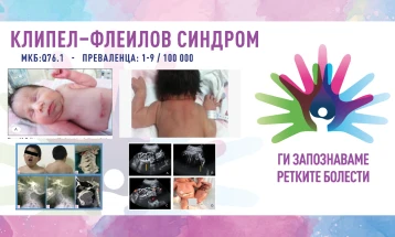 „Ги запознаваме ретките болести“: Клипел-Флеилов синдром/Синдром на цервикална фузија на пршлените