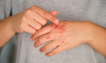 Контактните дерматити од растенија и полени - најчесто алергенско заболување на кожата во пролет